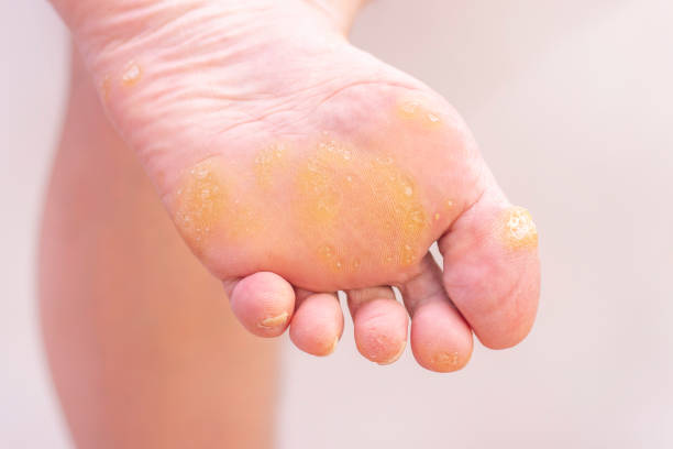 Foot Corn Prevention