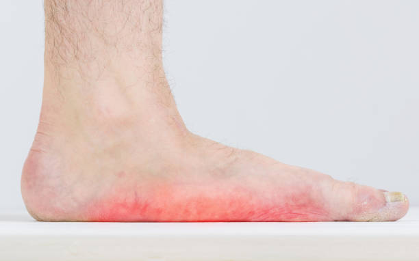 What Are Flat Feet?
