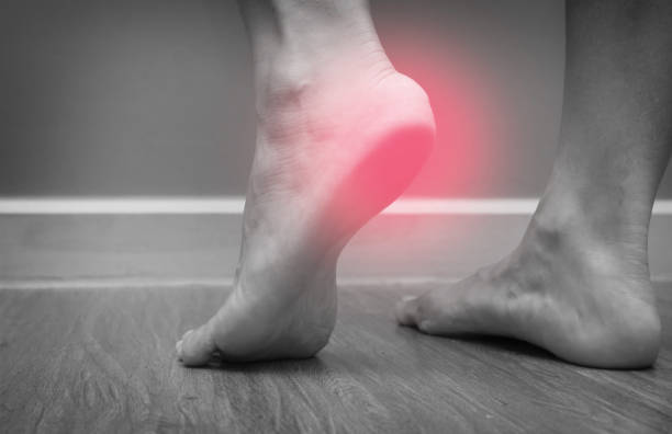 Home Remedies for Plantar Fasciitis